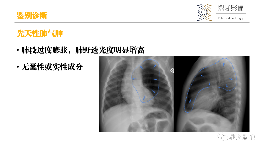 影像PPT - 【PPT】先天性肺囊性腺瘤样畸形-26