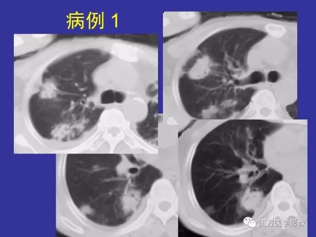 影像PPT - 【PPT】“空气新月征”的CT诊断和鉴别诊断-2
