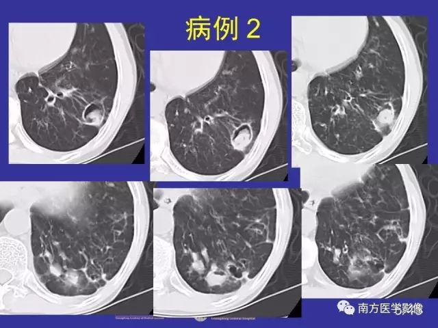 影像PPT - 【PPT】“空气新月征”的CT诊断和鉴别诊断-5