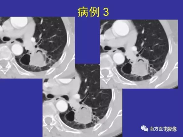 影像PPT - 【PPT】“空气新月征”的CT诊断和鉴别诊断-8