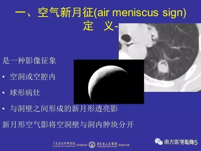 影像PPT - 【PPT】“空气新月征”的CT诊断和鉴别诊断-14