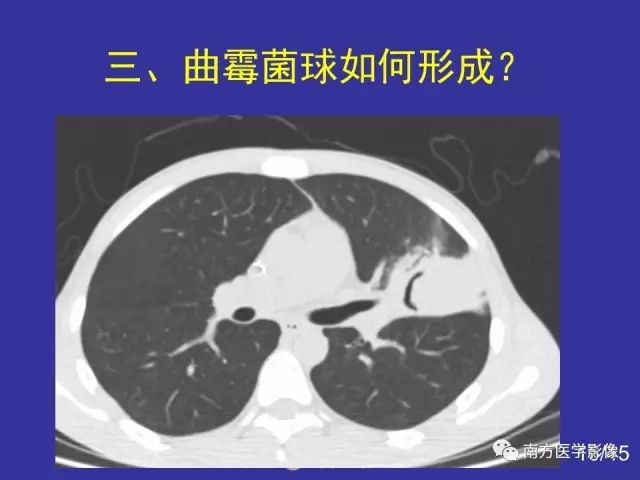 影像PPT - 【PPT】“空气新月征”的CT诊断和鉴别诊断-16