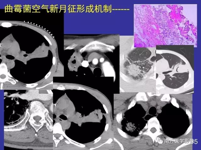 影像PPT - 【PPT】“空气新月征”的CT诊断和鉴别诊断-18