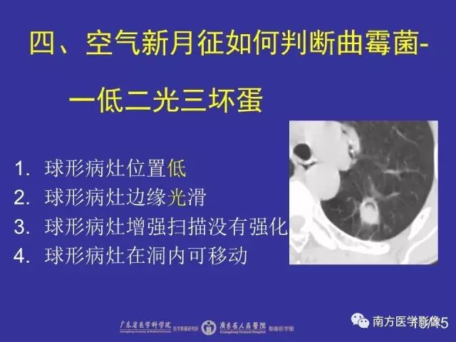 影像PPT - 【PPT】“空气新月征”的CT诊断和鉴别诊断-19