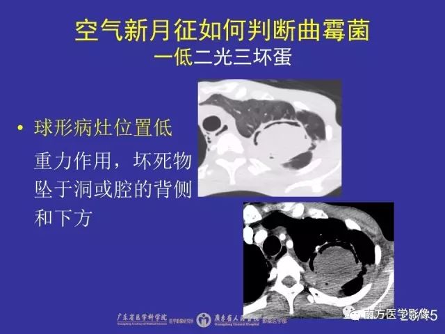 影像PPT - 【PPT】“空气新月征”的CT诊断和鉴别诊断-20