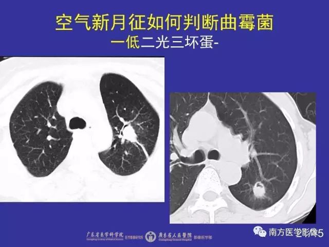 影像PPT - 【PPT】“空气新月征”的CT诊断和鉴别诊断-21
