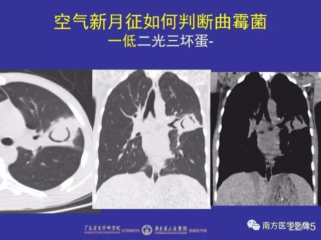 影像PPT - 【PPT】“空气新月征”的CT诊断和鉴别诊断-22