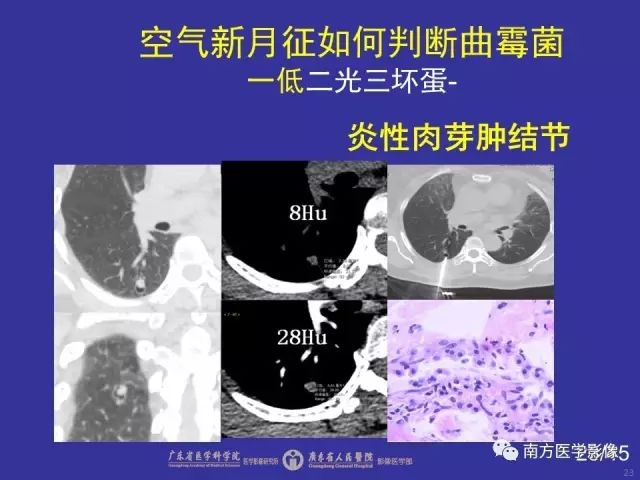 影像PPT - 【PPT】“空气新月征”的CT诊断和鉴别诊断-23