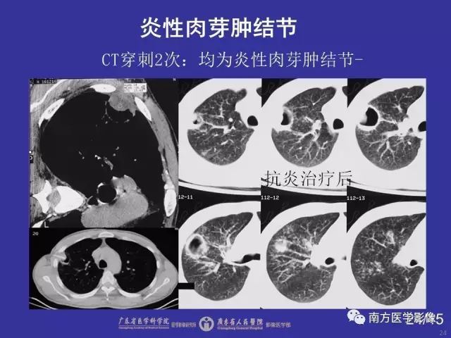 影像PPT - 【PPT】“空气新月征”的CT诊断和鉴别诊断-24