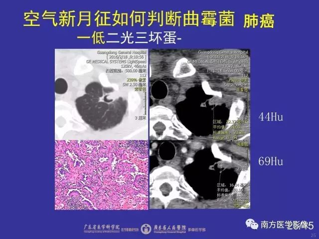 影像PPT - 【PPT】“空气新月征”的CT诊断和鉴别诊断-25