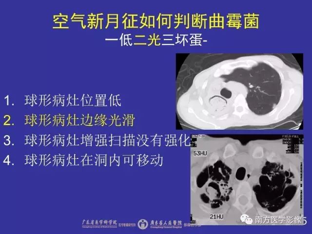 影像PPT - 【PPT】“空气新月征”的CT诊断和鉴别诊断-26