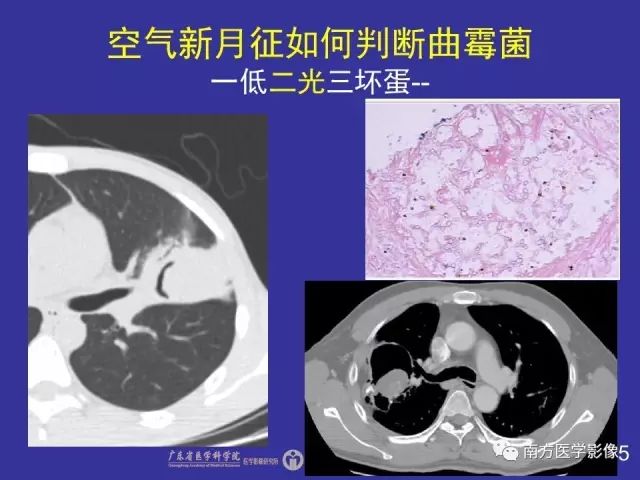 影像PPT - 【PPT】“空气新月征”的CT诊断和鉴别诊断-27