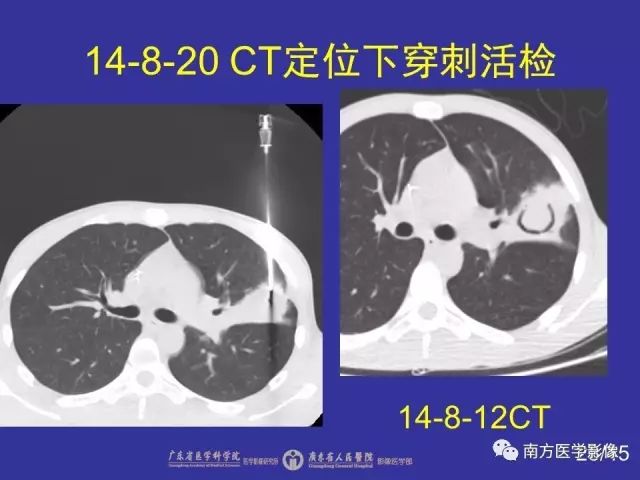 影像PPT - 【PPT】“空气新月征”的CT诊断和鉴别诊断-28