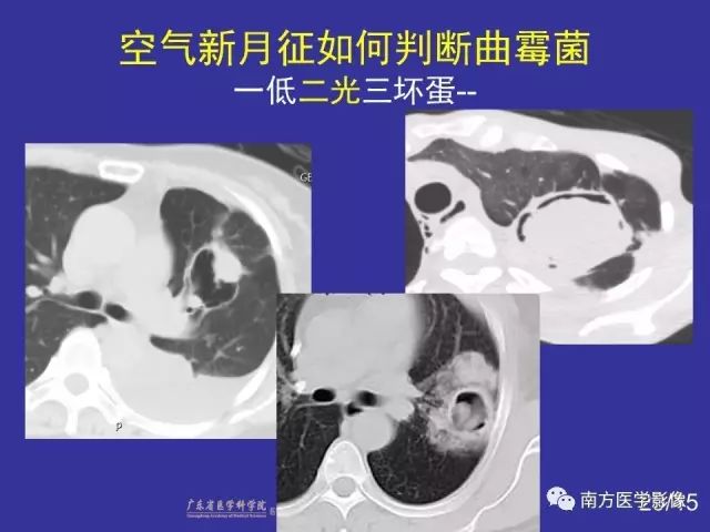 影像PPT - 【PPT】“空气新月征”的CT诊断和鉴别诊断-29