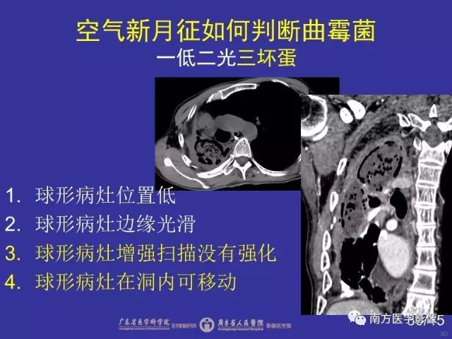 影像PPT - 【PPT】“空气新月征”的CT诊断和鉴别诊断-30