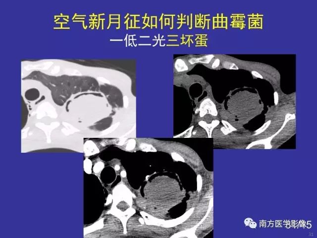 影像PPT - 【PPT】“空气新月征”的CT诊断和鉴别诊断-31