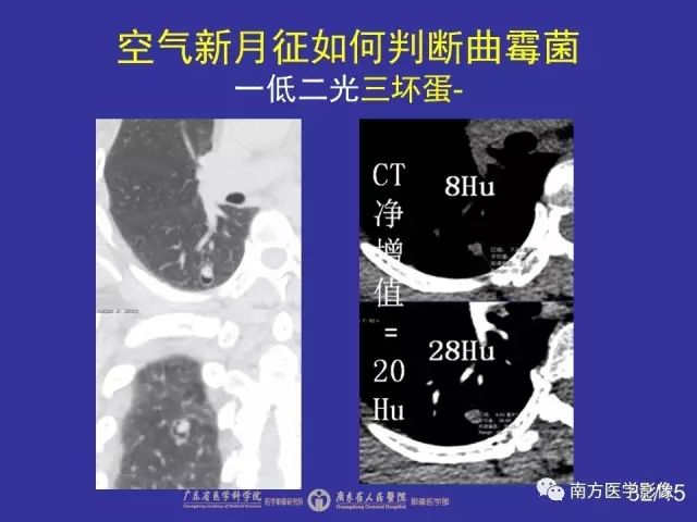 影像PPT - 【PPT】“空气新月征”的CT诊断和鉴别诊断-32