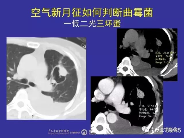 影像PPT - 【PPT】“空气新月征”的CT诊断和鉴别诊断-33