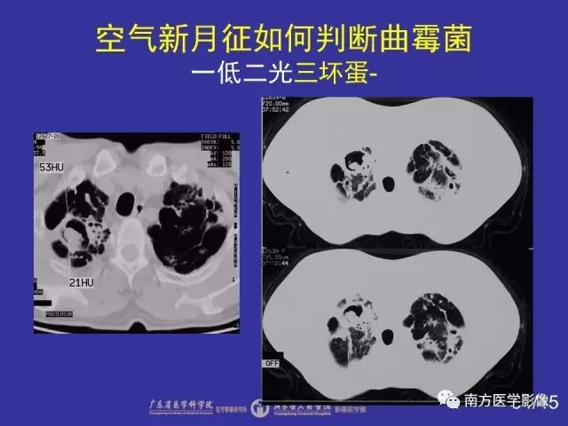 影像PPT - 【PPT】“空气新月征”的CT诊断和鉴别诊断-34