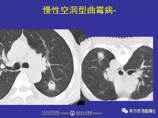 影像PPT - 【PPT】“空气新月征”的CT诊断和鉴别诊断-35