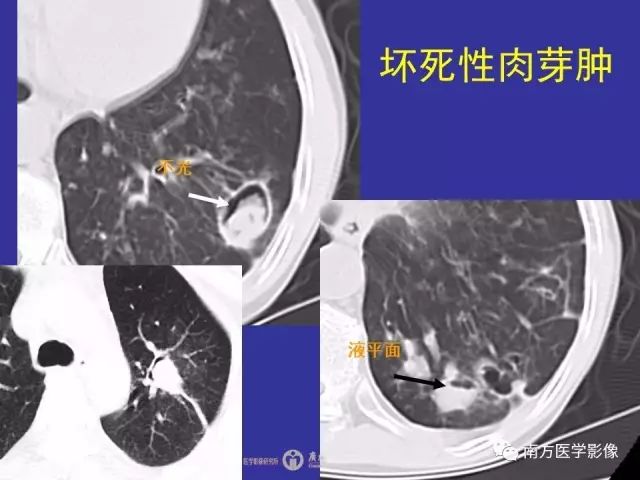 影像PPT - 【PPT】“空气新月征”的CT诊断和鉴别诊断-39