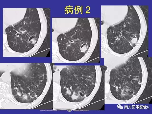 影像PPT - 【PPT】“空气新月征”的CT诊断和鉴别诊断-38
