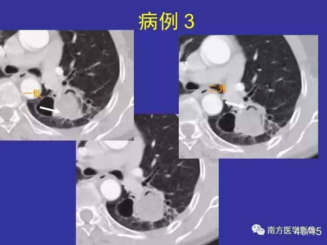影像PPT - 【PPT】“空气新月征”的CT诊断和鉴别诊断-40