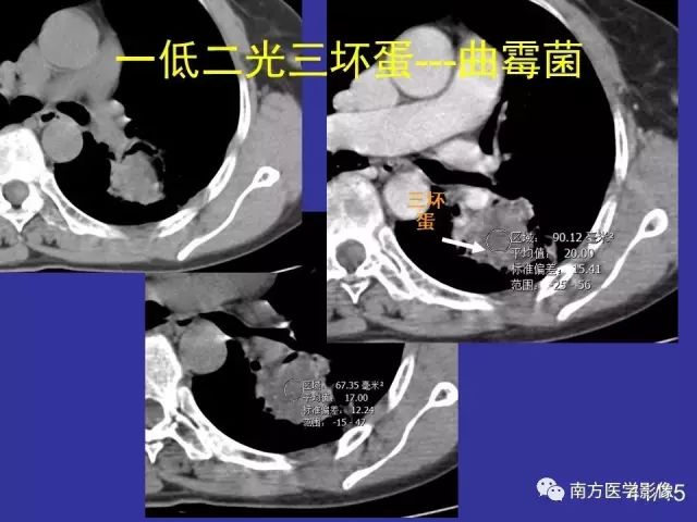 影像PPT - 【PPT】“空气新月征”的CT诊断和鉴别诊断-41