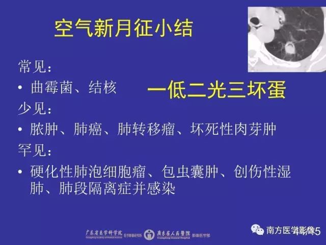 影像PPT - 【PPT】“空气新月征”的CT诊断和鉴别诊断-44