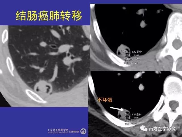 影像PPT - 【PPT】“空气新月征”的CT诊断和鉴别诊断-43