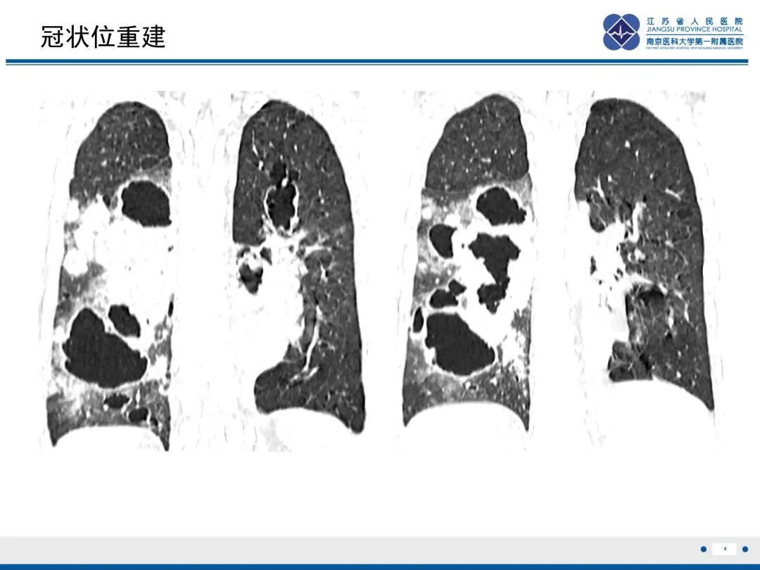 影像PPT - 【PPT】复发性呼吸道乳头状瘤病-5