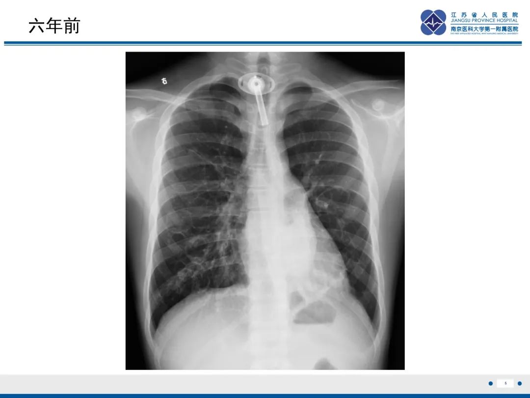 影像PPT - 【PPT】复发性呼吸道乳头状瘤病-6