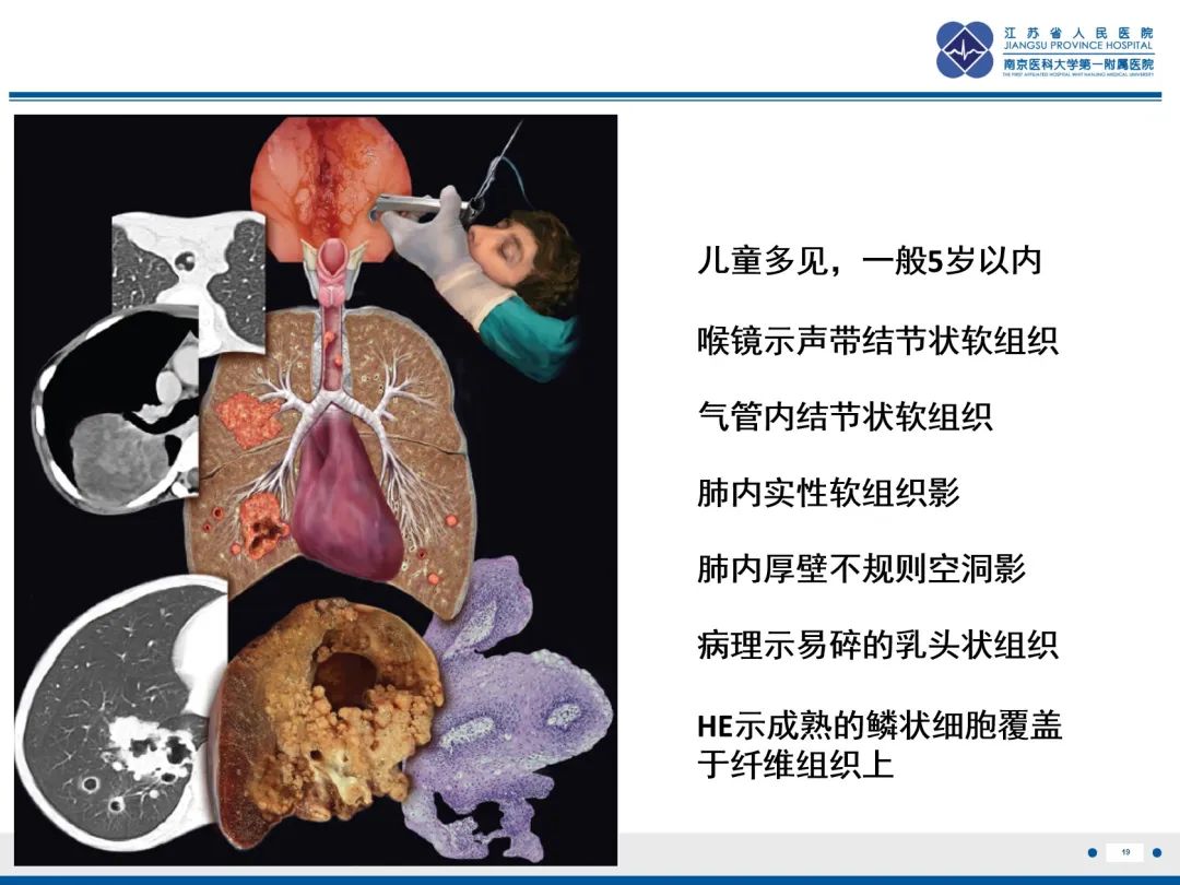 影像PPT - 【PPT】复发性呼吸道乳头状瘤病-20