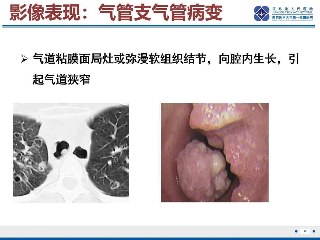 影像PPT - 【PPT】复发性呼吸道乳头状瘤病-21