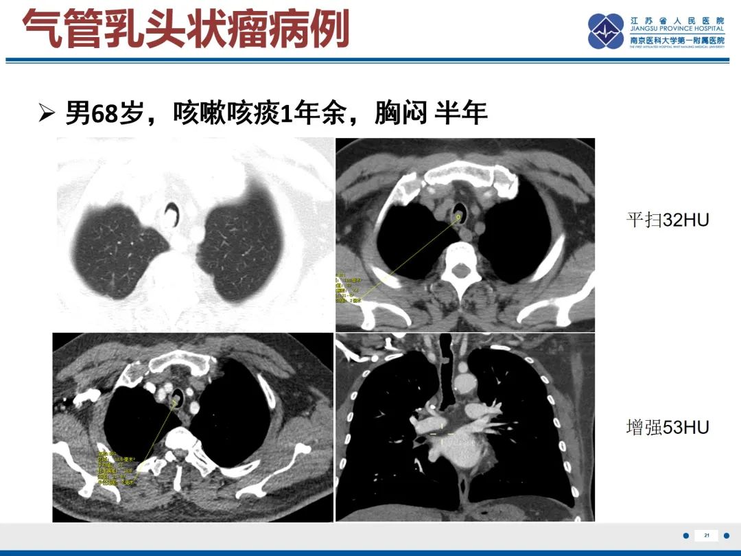 影像PPT - 【PPT】复发性呼吸道乳头状瘤病-22