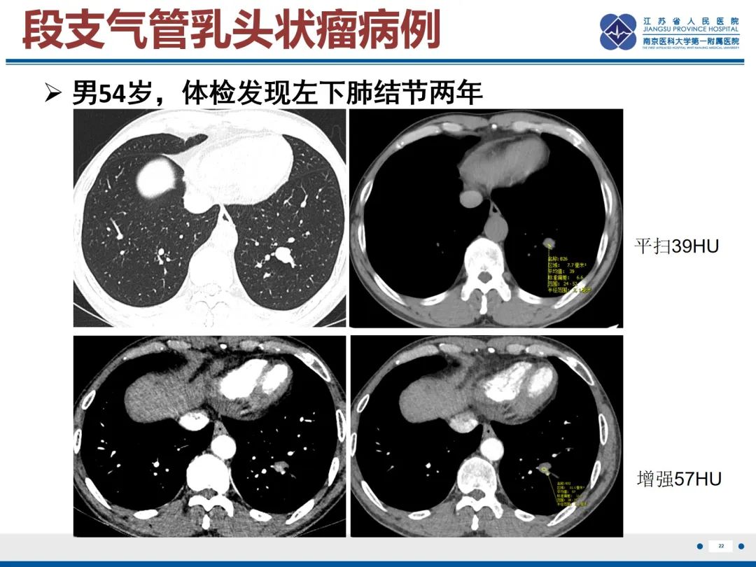 影像PPT - 【PPT】复发性呼吸道乳头状瘤病-23
