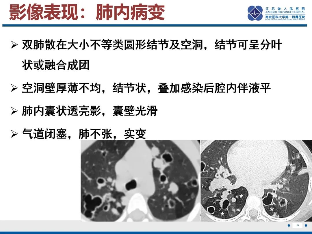 影像PPT - 【PPT】复发性呼吸道乳头状瘤病-24