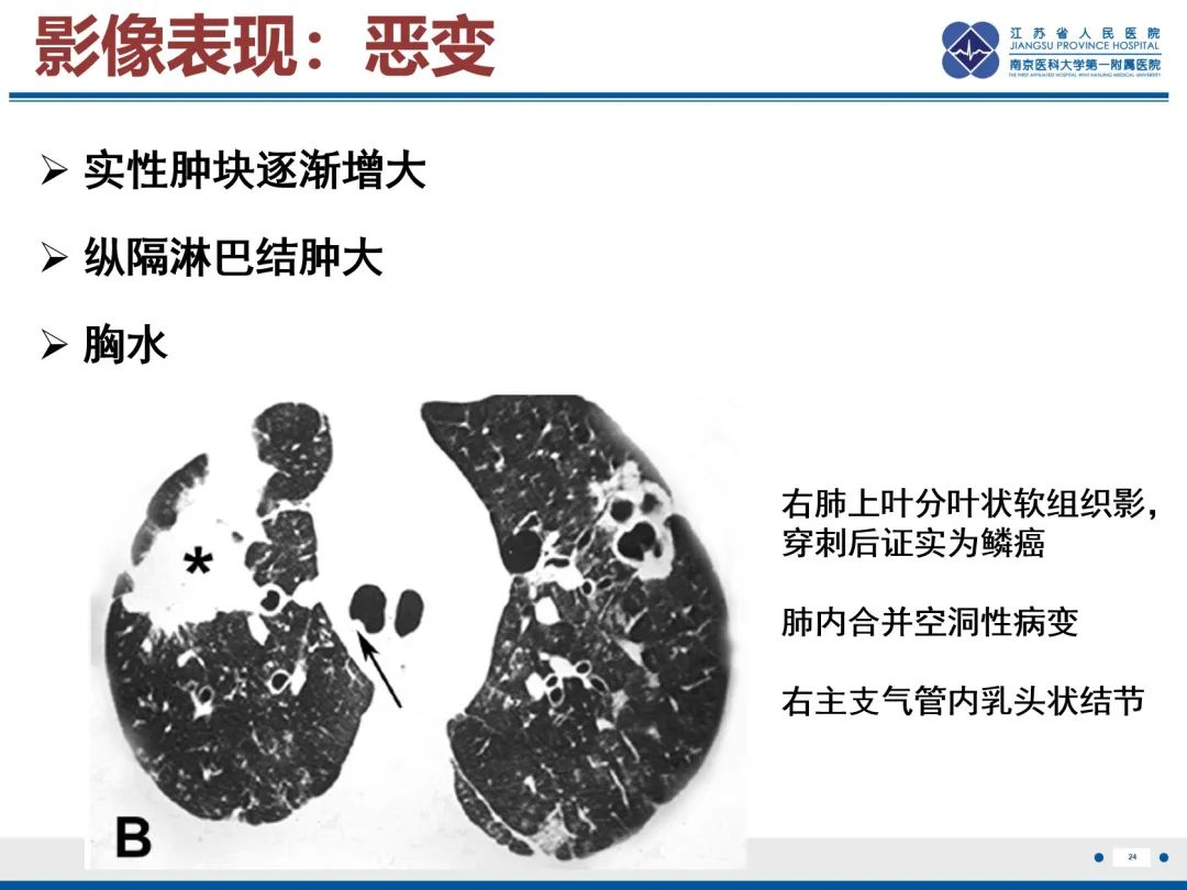 影像PPT - 【PPT】复发性呼吸道乳头状瘤病-25