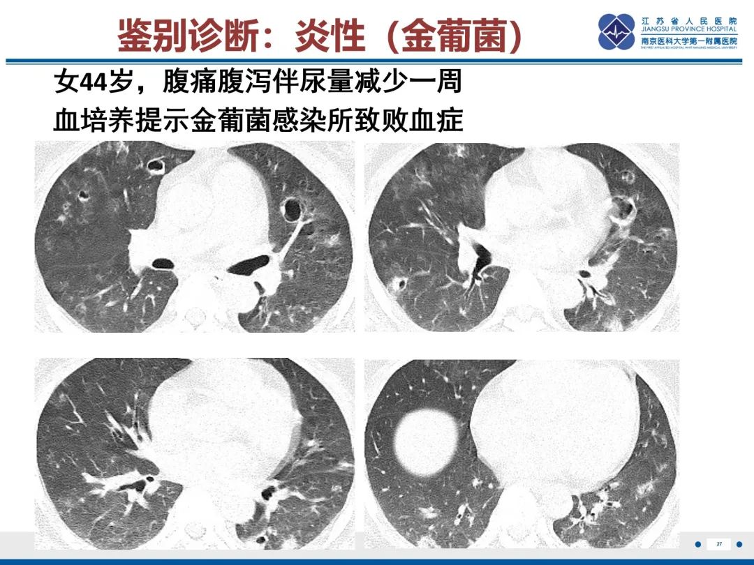 影像PPT - 【PPT】复发性呼吸道乳头状瘤病-28