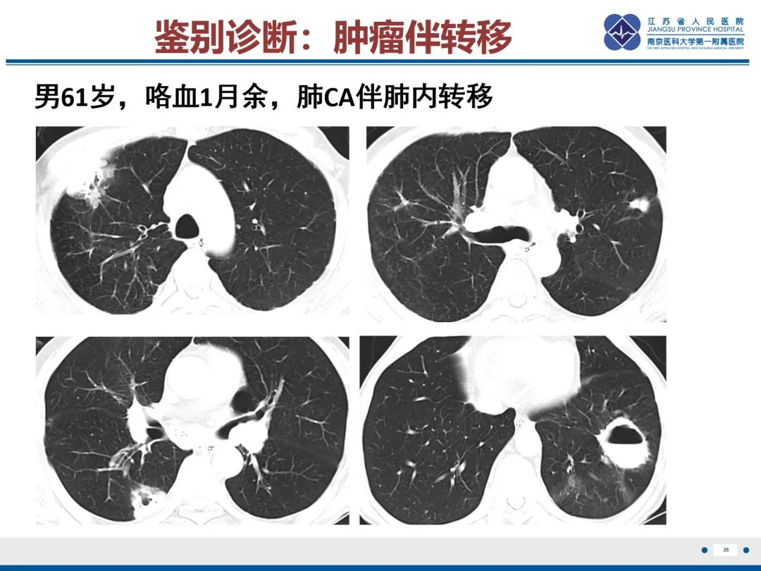 影像PPT - 【PPT】复发性呼吸道乳头状瘤病-29