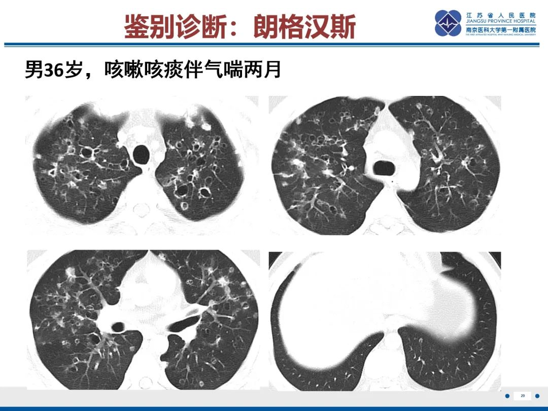 影像PPT - 【PPT】复发性呼吸道乳头状瘤病-30