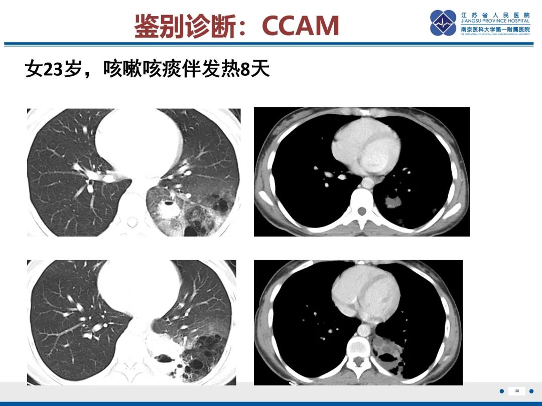 影像PPT - 【PPT】复发性呼吸道乳头状瘤病-31
