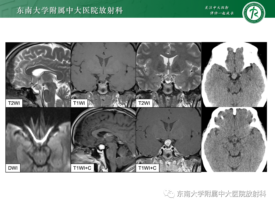 影像PPT - 【PPT】垂体柄病变的影像诊断-2