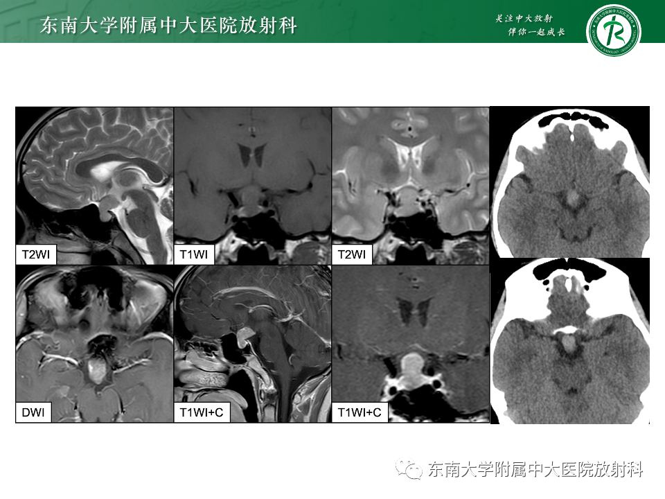 影像PPT - 【PPT】垂体柄病变的影像诊断-5