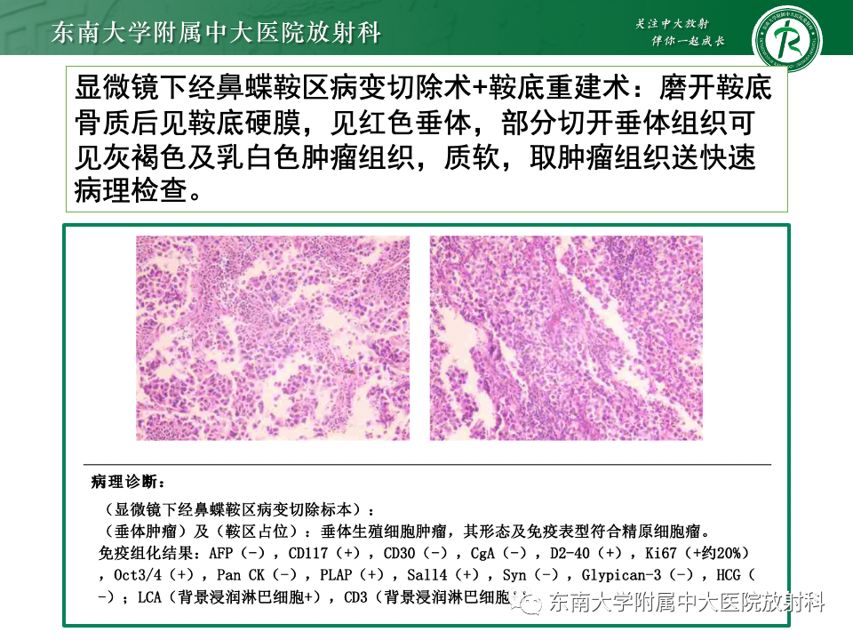 影像PPT - 【PPT】垂体柄病变的影像诊断-6