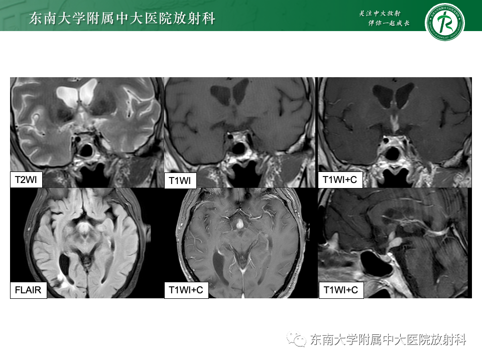 影像PPT - 【PPT】垂体柄病变的影像诊断-8