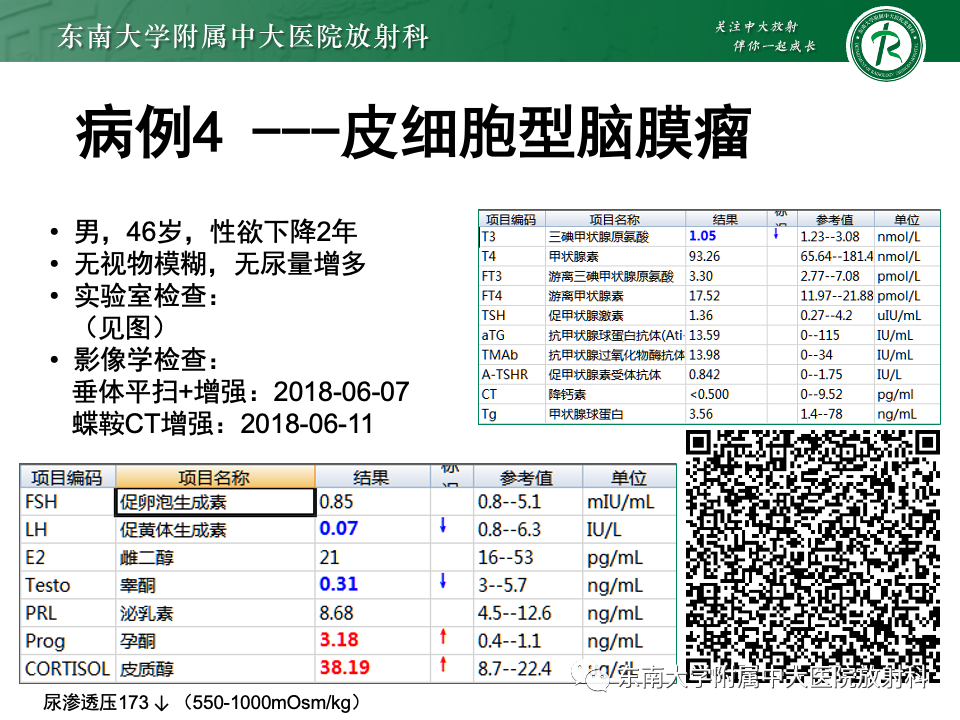 影像PPT - 【PPT】垂体柄病变的影像诊断-10