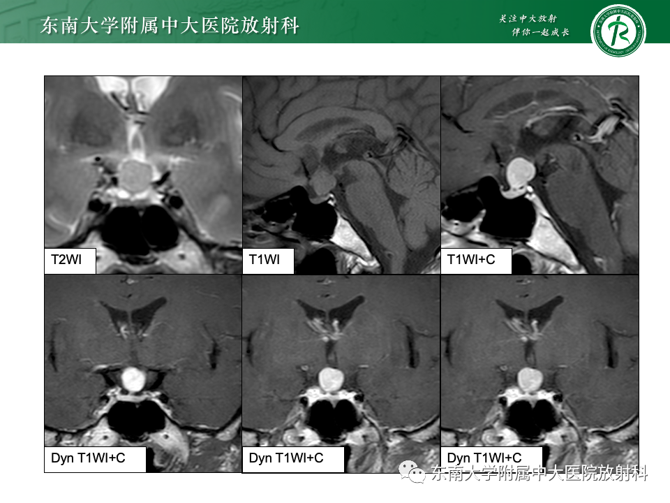 影像PPT - 【PPT】垂体柄病变的影像诊断-11
