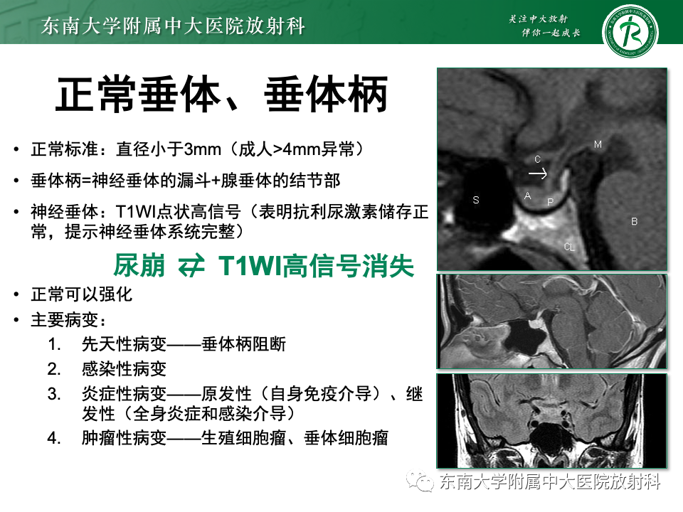 影像PPT - 【PPT】垂体柄病变的影像诊断-18