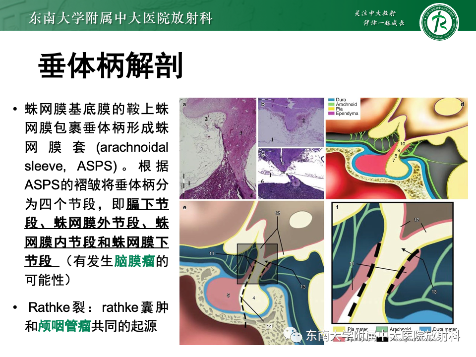 影像PPT - 【PPT】垂体柄病变的影像诊断-19